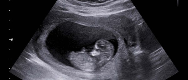 ecografía fetal, cardiología pediátrica, clínica canabal